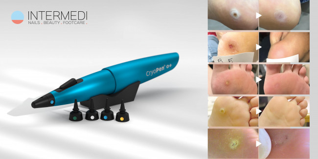 Kennismakingsdemo AVOND CryoPen O+ 25 maart HARELBEKE